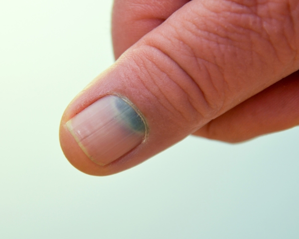 Daumen mit blauer Nagelprellung